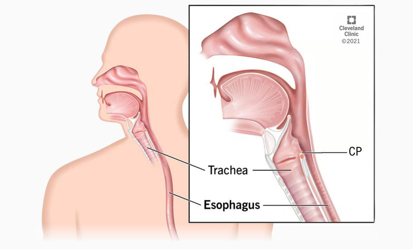 Anatomy of Burping Graphic of head and neck anatomy, labeling the trachea, esophagus, and CP muscle.